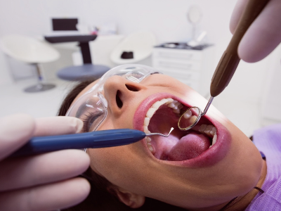 Dental Fillings